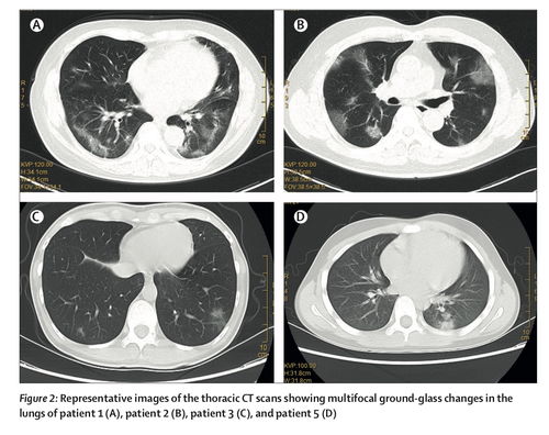 小儿GCSH基因突变能治吗