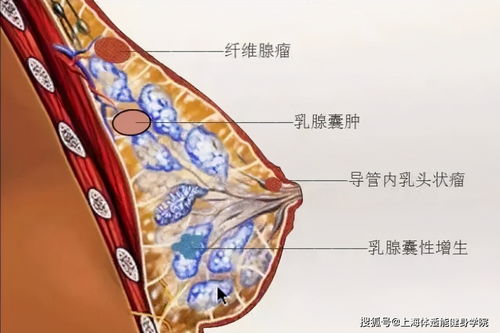 乳腺结节BI-RADS分级怎么看