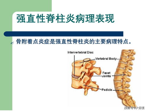 世界,强直性,脊柱,炎日