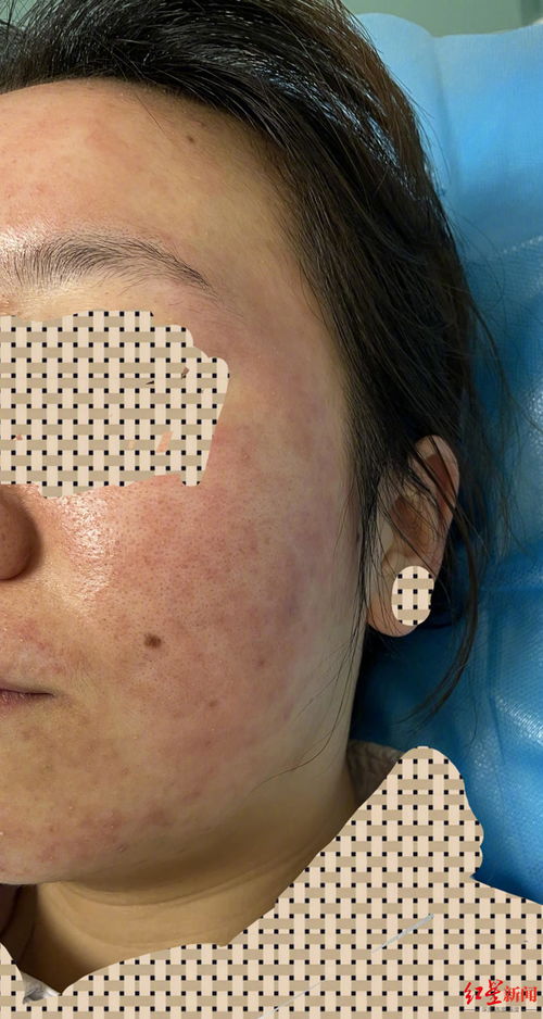 世界特应性皮炎日世界特应性皮炎日