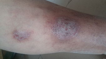 世界特应性皮炎日世界特应性皮炎日