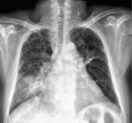 世界干燥综合征日世界干燥综合征日 世界干燥综合征日世界干燥综合征日