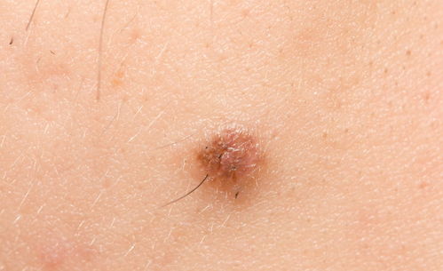 肝硬化-面色发黑蜘蛛痣出现，肝病科医生：这是肝硬化失代偿期的典型体征