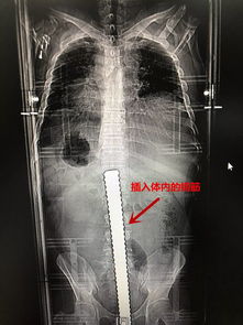 肠癌-肠癌术后造口患者的生活，肛肠科护士说很多人比术前活得体面