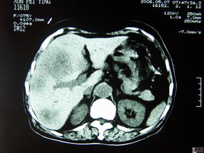 肝细胞癌-甲胎蛋白正常也不能排除肝癌,肝胆外科医生说B超有结节 肝细胞癌-甲胎蛋白正常也不能排除肝癌,肝胆外科医生说B超有结节