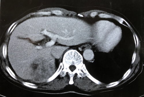肝细胞癌-甲胎蛋白正常也不能排除肝癌,肝胆外科医生说B超有结节 肝细胞癌-甲胎蛋白正常也不能排除肝癌,肝胆外科医生说B超有结节