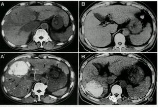 肝癌-手术切除了肝癌，五年没复发是不是就治愈了？肝胆外科医生摇头