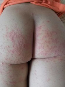 儿童扁桃体发炎怎么办