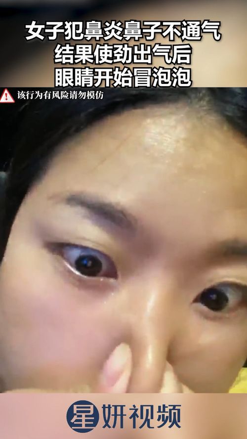 世界鼻窦炎日世界鼻窦炎日