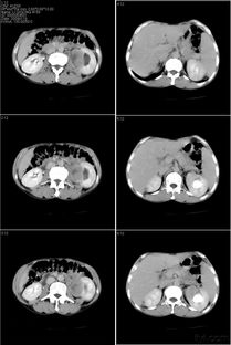 结直肠癌-大便变细带血，肠镜发现环周肿物