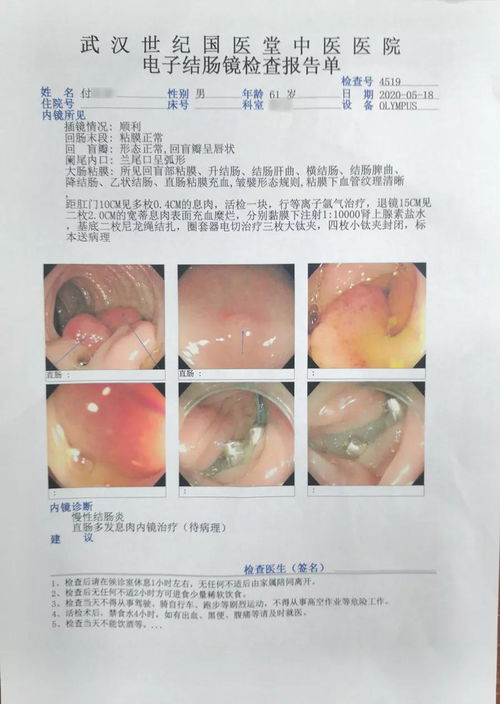 结直肠癌-大便变细带血，肠镜发现环周肿物