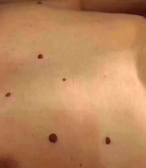 皮肤癌-脸上长了个痣没在意,抓破后一直不愈合,皮肤科医生让做病理 皮肤癌-脸上长了个痣没在意,抓破后一直不愈合,皮肤科医生让做病理