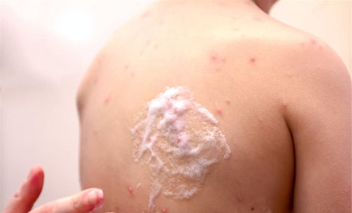 皮肤癌-脸上长了个痣没在意,抓破后一直不愈合,皮肤科医生让做病理 皮肤癌-脸上长了个痣没在意,抓破后一直不愈合,皮肤科医生让做病理