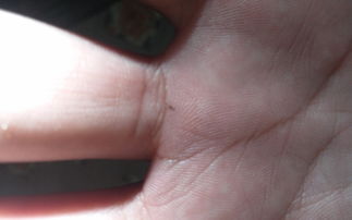 皮肤癌-脸上长了个痣没在意,抓破后一直不愈合,皮肤科医生让做病理 皮肤癌-脸上长了个痣没在意,抓破后一直不愈合,皮肤科医生让做病理