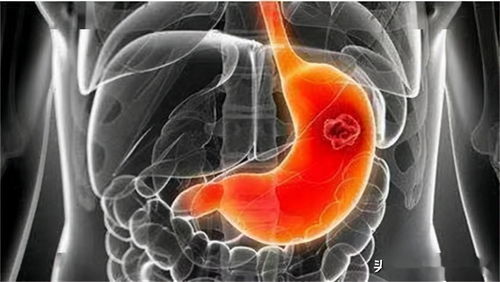 癌-过长几十年没管，反复糜烂最后确诊癌变