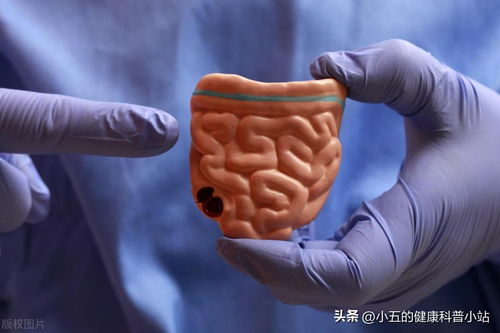 便秘：中医治便秘