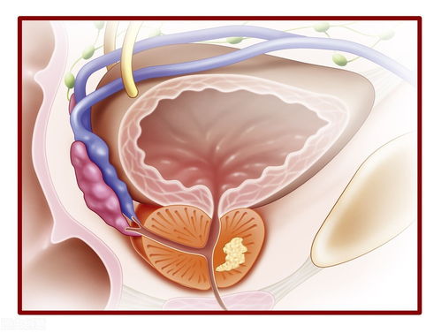 前列腺炎有什么症状？尿频尿急尿不尽