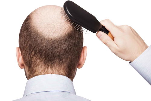 压力太大会导致脱发吗？真的会