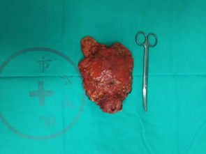 尿路上皮癌-膀胱镜活检尿路上皮癌