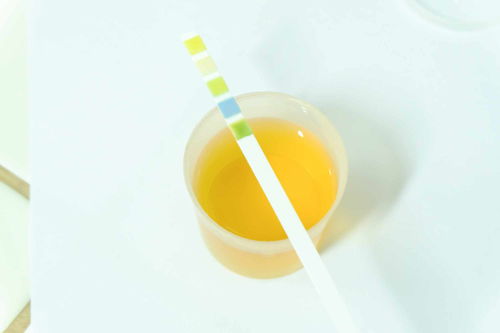 泡沫尿-尿里泡沫多以为蛋白尿，肾内科医生接了一杯水说放十分钟再看