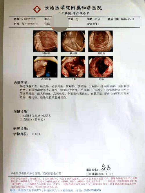 癌-血糖突然控制不好，内分泌科医生建议查，结果发现了早期肿瘤
