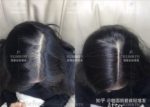 头顶头发稀疏露出头皮，怎么拯救