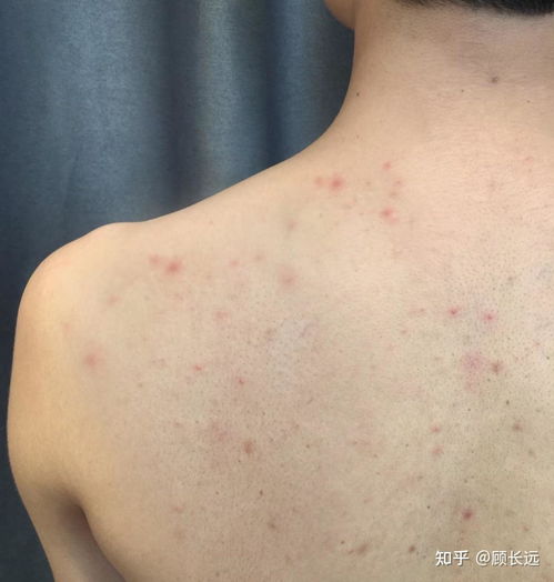 上有疙瘩摸到小硬块要当心