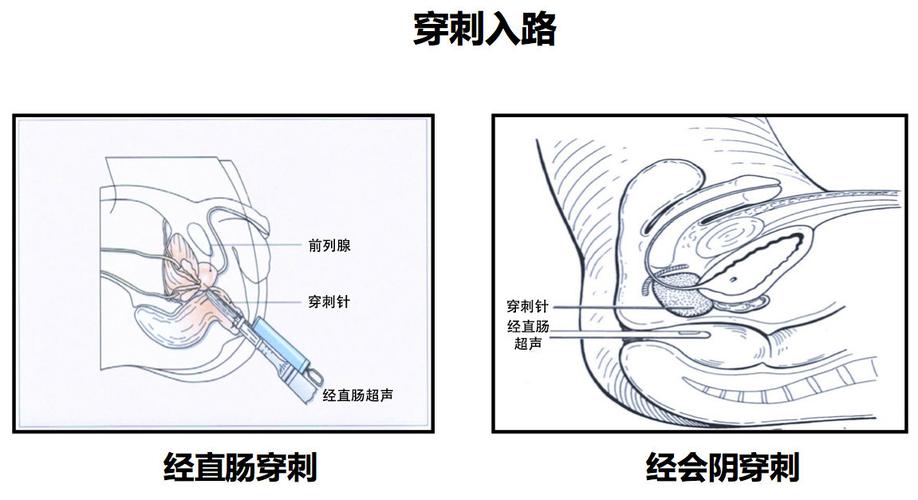 前列腺穿刺活检疼吗