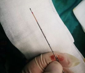 前列腺穿刺活检疼吗