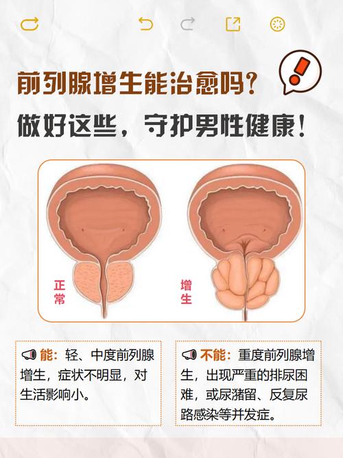 前列腺增生从夜尿增多开始