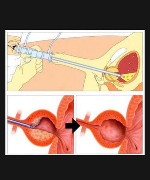 前列腺增生从夜尿增多开始