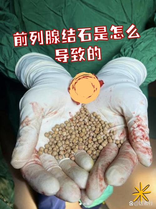 前列腺,结石,石头,在里面