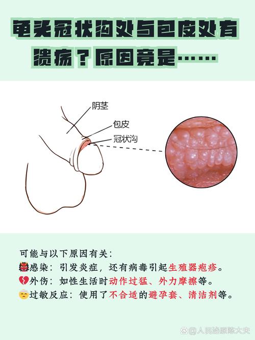 冠状沟溃疡久不愈合要警惕