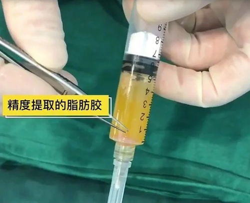 冠状沟溃疡久不愈合要警惕