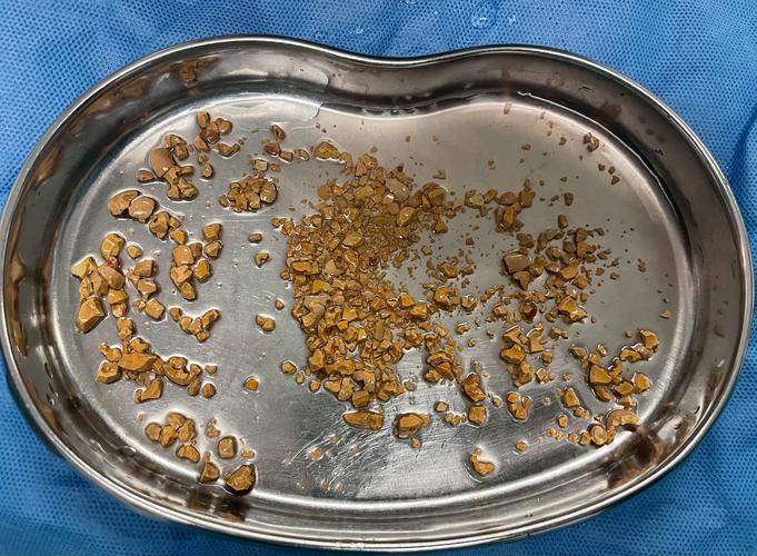 前列腺结石是石头长在里面了吗