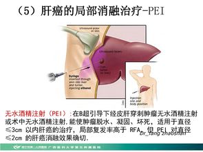 Asherman综合征怎么治疗