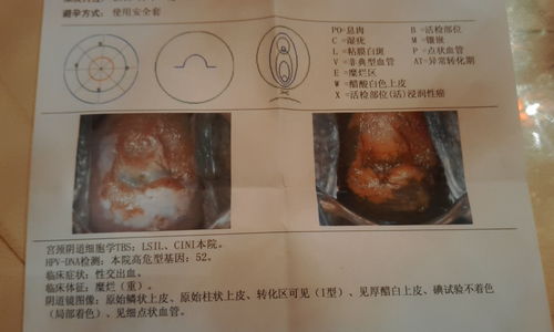 CIN3级是原位癌吗子宫全切还是锥切保子宫