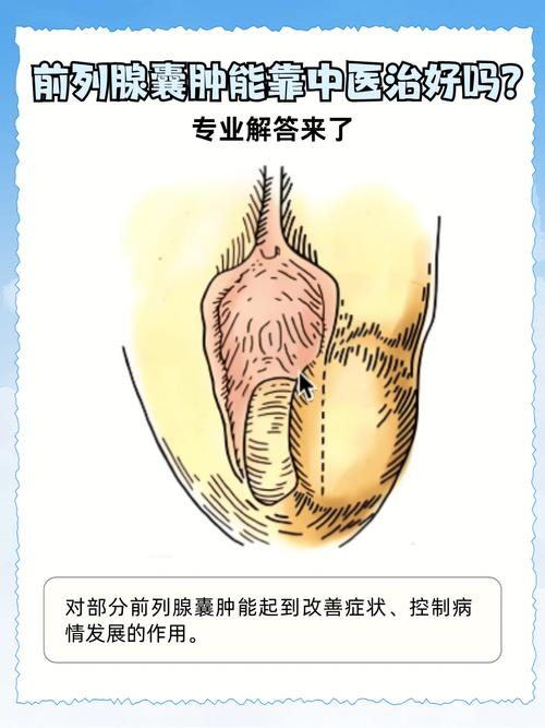 前列腺囊肿需要治疗吗