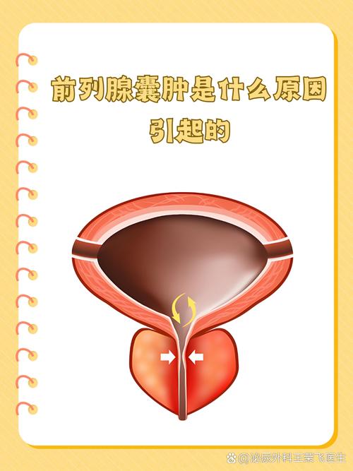 前列腺囊肿需要治疗吗