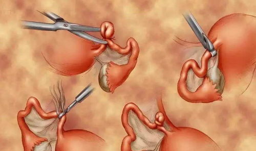 TRAM皮瓣和DIEP皮瓣有什么区别哪个创伤小