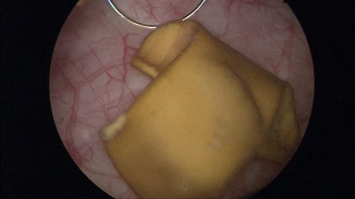 前列腺大小正常值是多少