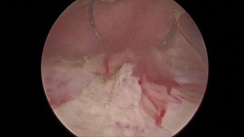 前列腺大小正常值是多少
