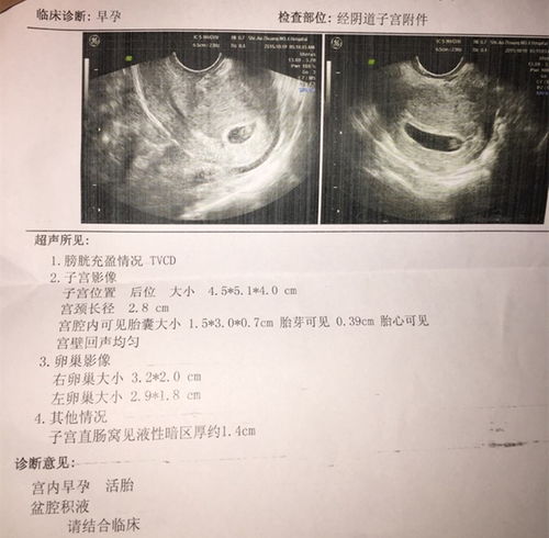 乳腺增生会癌变吗多久复查一次B超