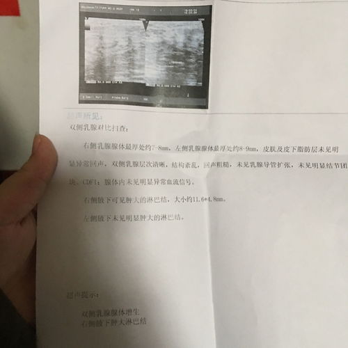 乳腺增生会癌变吗多久复查一次B超