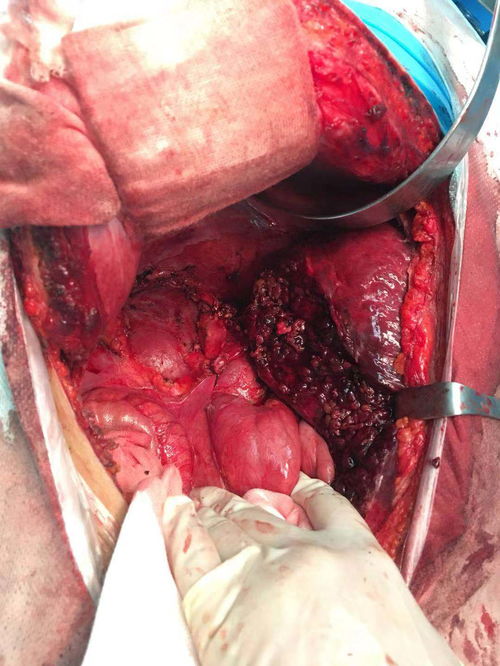 乳腺纤维腺瘤需要手术吗多大需要切除