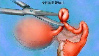 乳腺管堵塞反复发作是什么原因怎么预防