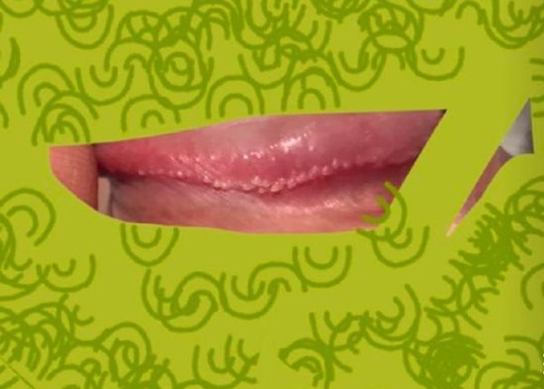 冠状,珍珠,需要,治疗