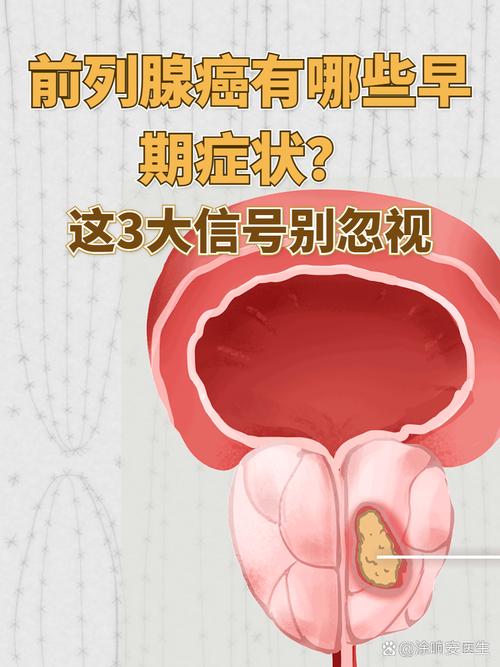 前列腺癌早期能治愈吗