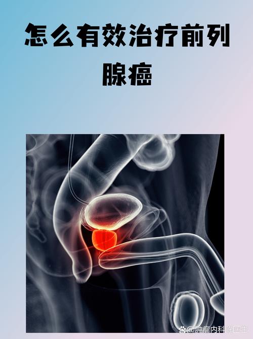 前列腺癌早期能治愈吗