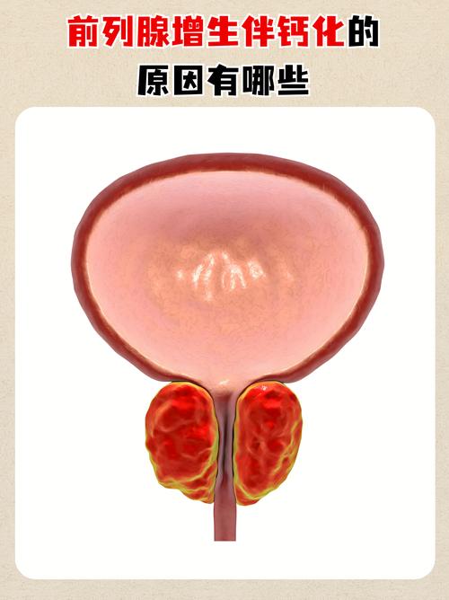 前列腺钙化是前列腺炎留下的疤吗